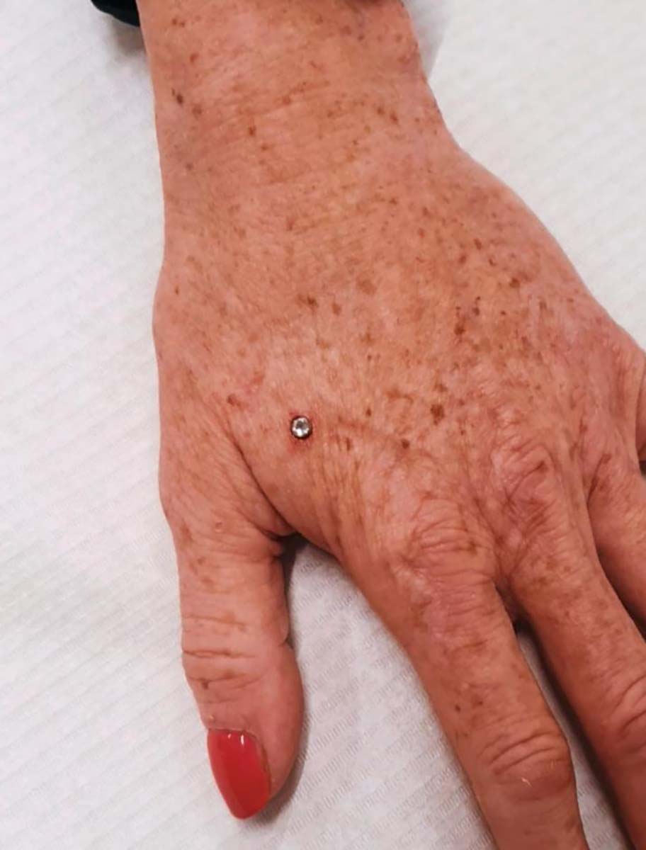 Dermal Ein Hautankerpiercing (Dermal) in der Hand