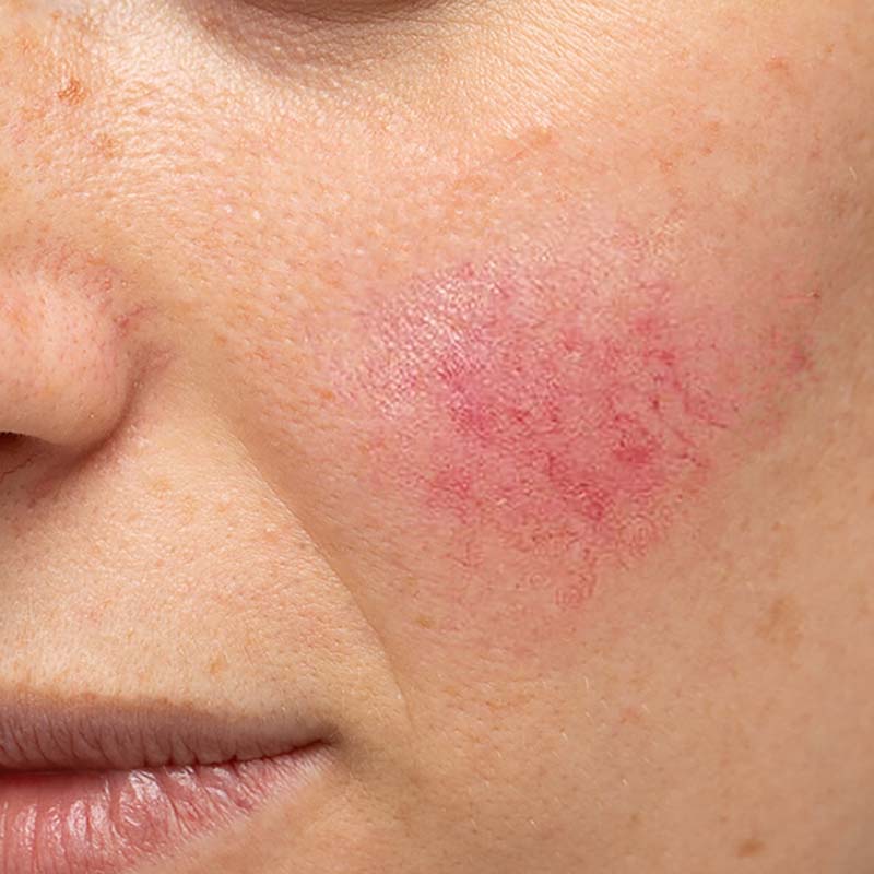 couperose-rosacea Rosacea und Couperose lasern lassen in Zofingen bei für immer & ewig - die vorher-nachher Ergebnisse werden sie überzeugen