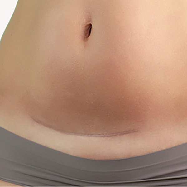 vorher nachher narben lasern Narben lasern lassen - Vorher-Nachher-Bild eines Kunden in Zofingen